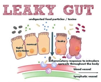 Leaky Gut Explained in An Easy Way